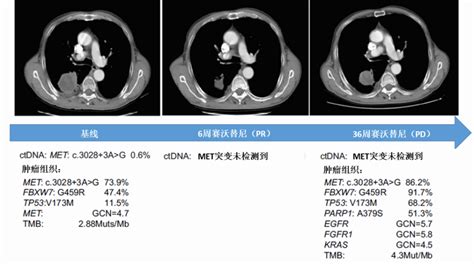 Met Tki 为 Met Ex14 跳突肺肉瘤样癌患者带来显著获益，配对基因检测揭示耐药机制 治疗 肿瘤 包括