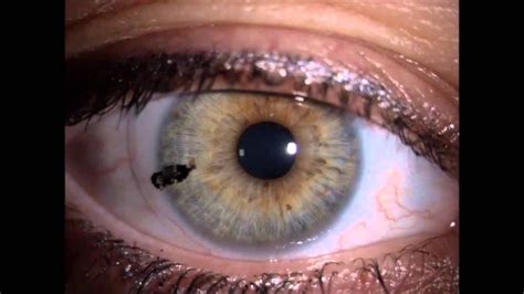 A soft contactlens rotates 360 degrees! - YouTube