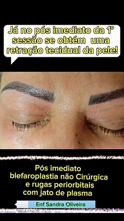 Blefaroplastia Sem Corte Com Jato De Plasma Youtube