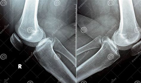 Plain X Ray On Knee Joint Showing Joint Space Narrowing And Subchondral Sclerosis On Medial