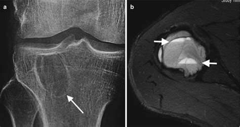 Bone And Synovial Tumors Radiology Key