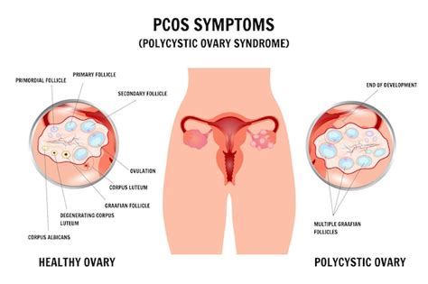 Premium Vector Medical Gynecology Infographic Of Pcos Symptoms