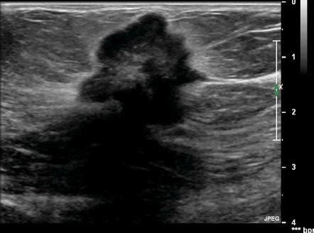 Breast Cancer Malignant Ultrasound Images