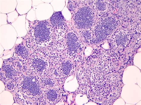 Pathology Outlines Lobular Carcinoma In Situ Lcis Classic