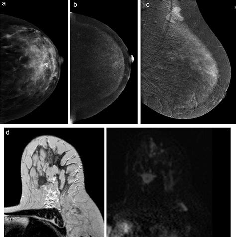 Contrast Enhanced Spectral Mammography Impact Of The Qualitative