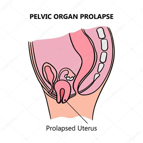 Prolapsed Uterus Of Women Diagrama General Con Texto Explicativo Para