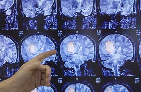 Immunotherapy And Treatments Offer Hope In Glioblastoma Acc