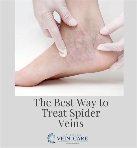 The Best Way to Treat Spider Veins