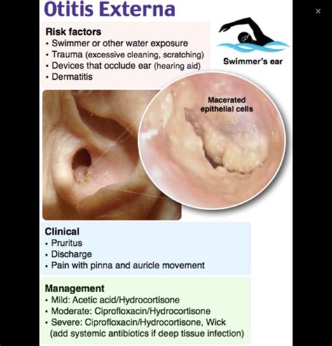 Otitis Externa And Otitis Media Flashcards Quizlet