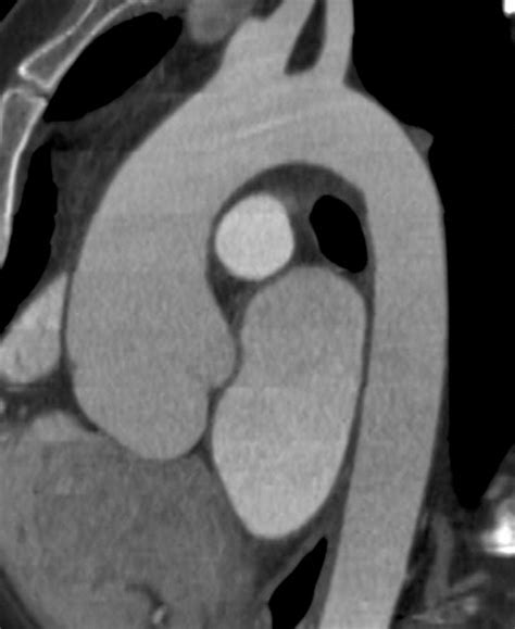 Multidetector Ct Of Thoracic Aortic Aneurysms Radiographics