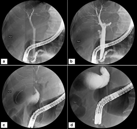 Endoscopic Transpapillary Stenting A Endoscopic Retrograde