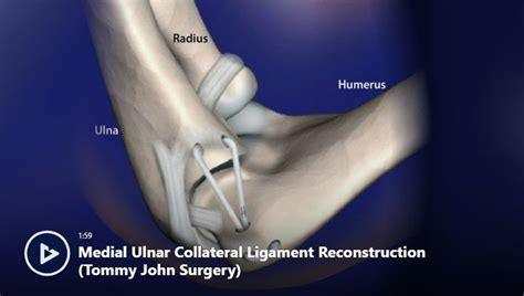 Elbow Conditions And Treatments Newport Orthopedic Institute