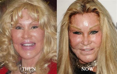 Jocelyn Wildenstein Plastic Surgery Before And After Face Photos