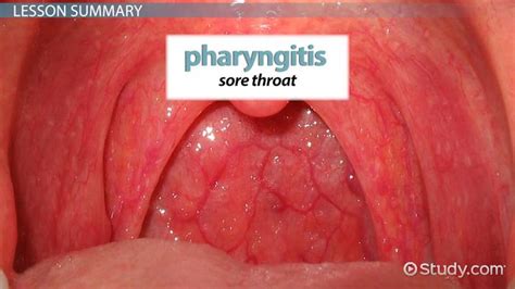 What Is Pharyngitis? - Definition, Causes, Symptoms & Treatment ...