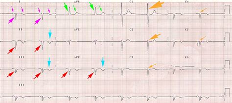 Dextrocardia Ecg Book