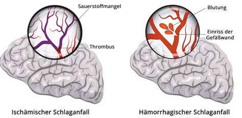 4 Symptome Schlaganfall