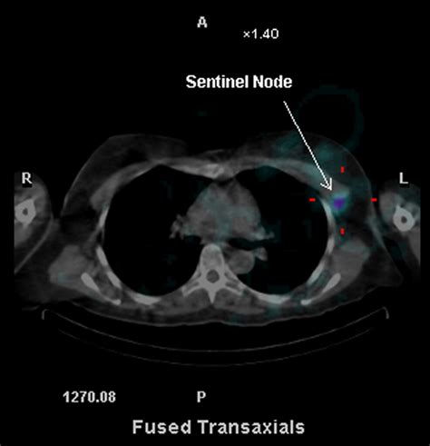 Sentinel Lymph Node Biopsy Information Dr Ben Lancashire