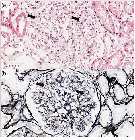 Hepatitis B Virus Associated Cryoglobulinaemia Diffuse Endocapillary