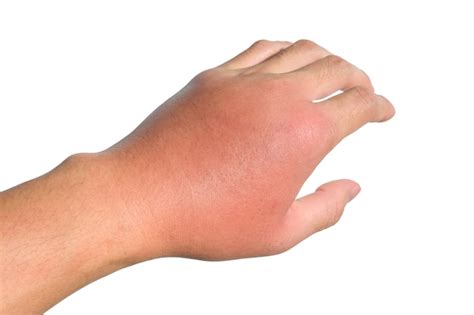 Inflammation, swelling, redness of the hand shows infection. insect bites. cellulitis at left ...