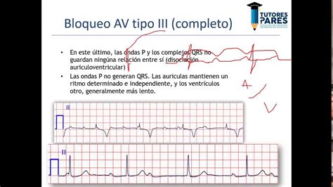 Guia En Electrocardiograma Arritmia Cardiaca Electrocardiografia | Images and Photos finder