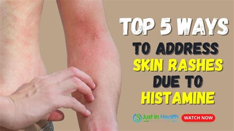 The Top Ways To Address Skin Rashes Due To Histamine Youtube