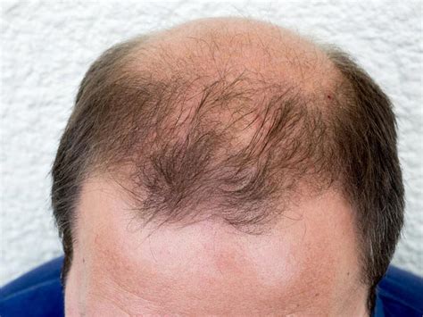 Alopecia Caderea Parului Cauze Si Tratament S N Tate De Fier