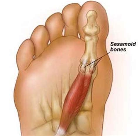 Condition Spotlight Sesamoiditis Watsonia Podiatry