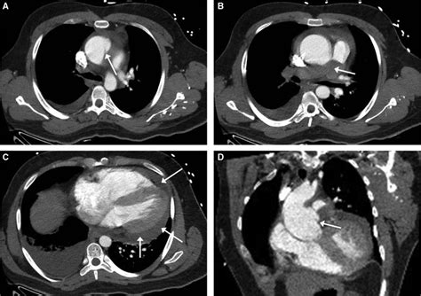 Type A Aortic Dissection Mimicking A Saddle Pulmonary Embolus On Computed Tomographic