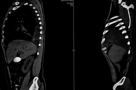 Computer Tomography Angiography Cta Of Whole Body Scan With 3d Reconstruction Ct Angiography For