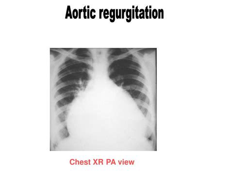 Ppt Aortic Regurgitation Powerpoint Presentation Free Download Id5751430