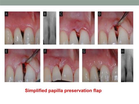 Minimal Invasive Techniques