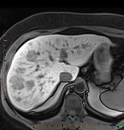 Hepatic adenomatosis | Radiology Case | Radiopaedia.org