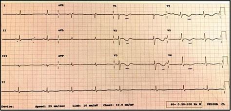 Loperamide Induced Cardiotoxicity A Case Overlooked Bmj Case Reports