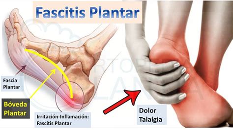 Fascitis Plantar Qué es Causas y Tratamientos Ortopedia Plantia