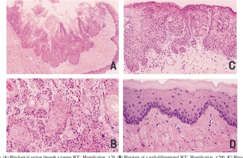 Xeroderma Pigmentosum Histology