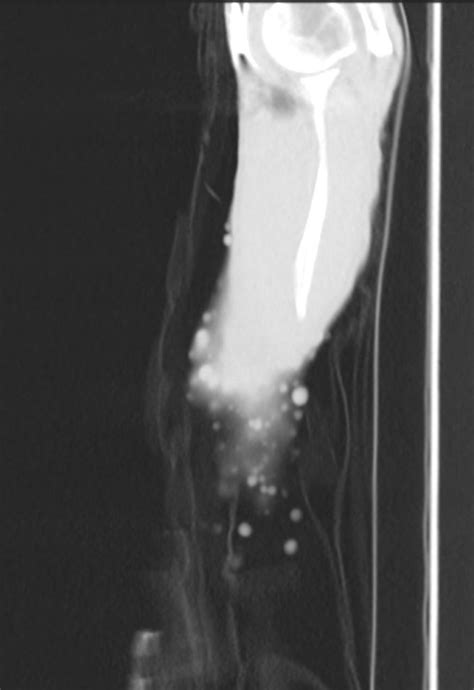 084lu 69m Neurofibromatosis Emphysema Lungs