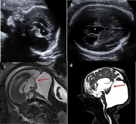 Prenatal Imaging Of Posterior Fossa Disorders A Review European