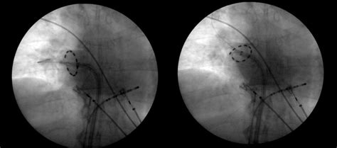 Position Of The Pulmonary Vein Ablation Catheter During Energy