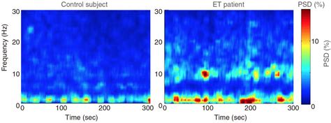 EEG Reveals Abnormal Brain Wav IMAGE EurekAlert Science News Releases