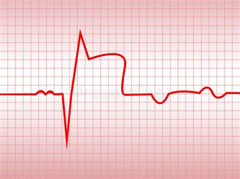 Chest Ecg Leads Placement Illustration Six Colored Electrocardiography