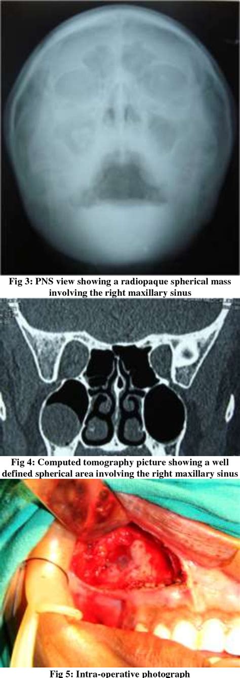 Figure From A Rare Presentation Of Odontogenic Keratocyst Mimicking