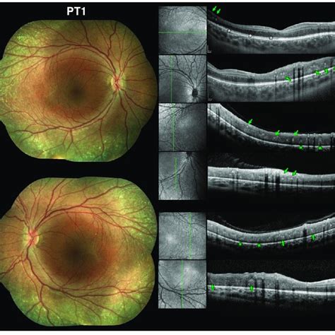 Spectral Domain Optical Coherence Tomography SD OCT Findings At The