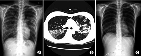 A Chest X Ray At Hospital Day 12 Shows Ground Glass Opacities And Download Scientific Diagram