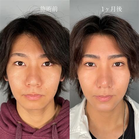 男の二重整形どう思う整形が不自然になってしまう理由も解説 【公式】astra Beauty Clinic（アストラビューティクリニック