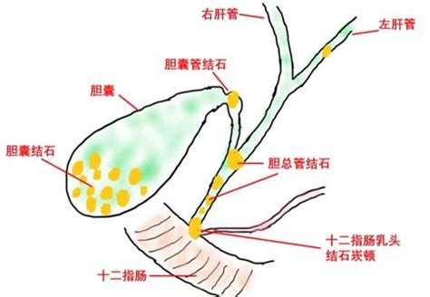 内镜微创再展绝技胆系结石一起治愈 微医（挂号网）