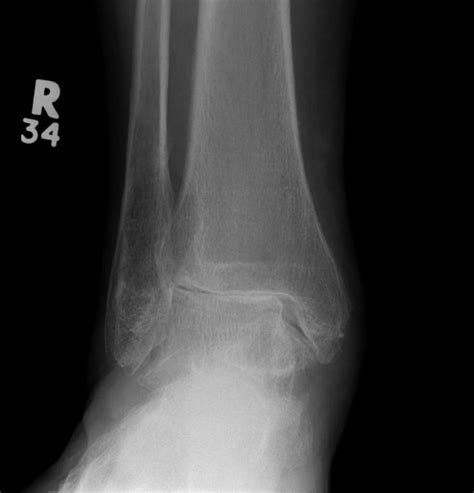Ankle Arthroplasty | The Bone School