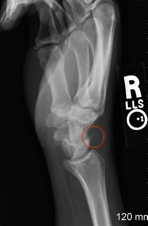 Avulsion Fractures Bone Fracture And Repair