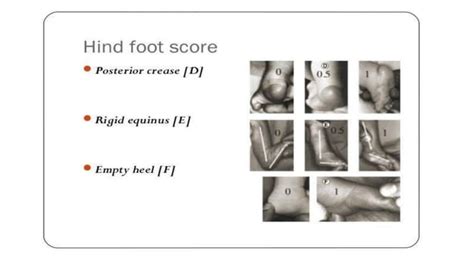 Club Foot Ctev Ppt