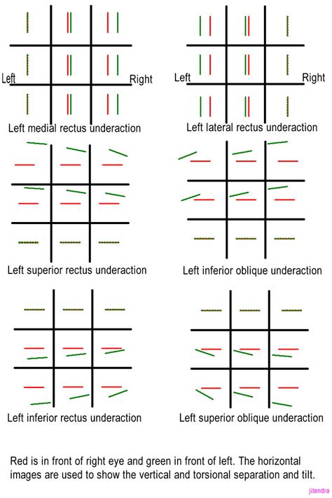 Diplopia And Hess Charting