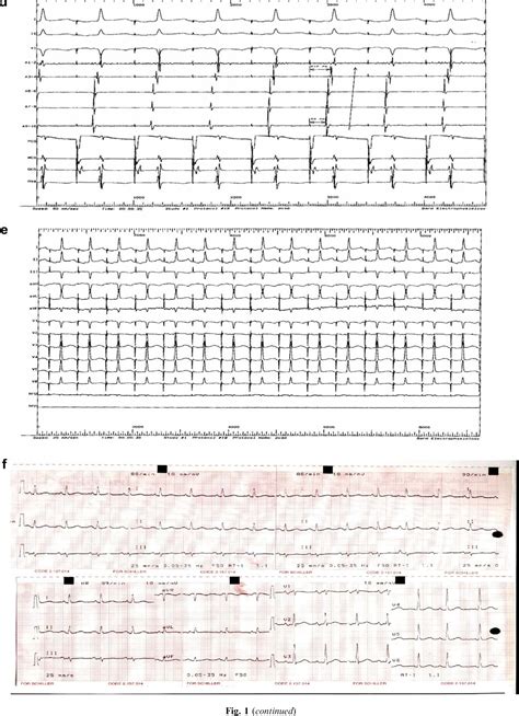 Figure From Recurrent Supraventricular Tachycardias Prevalence And